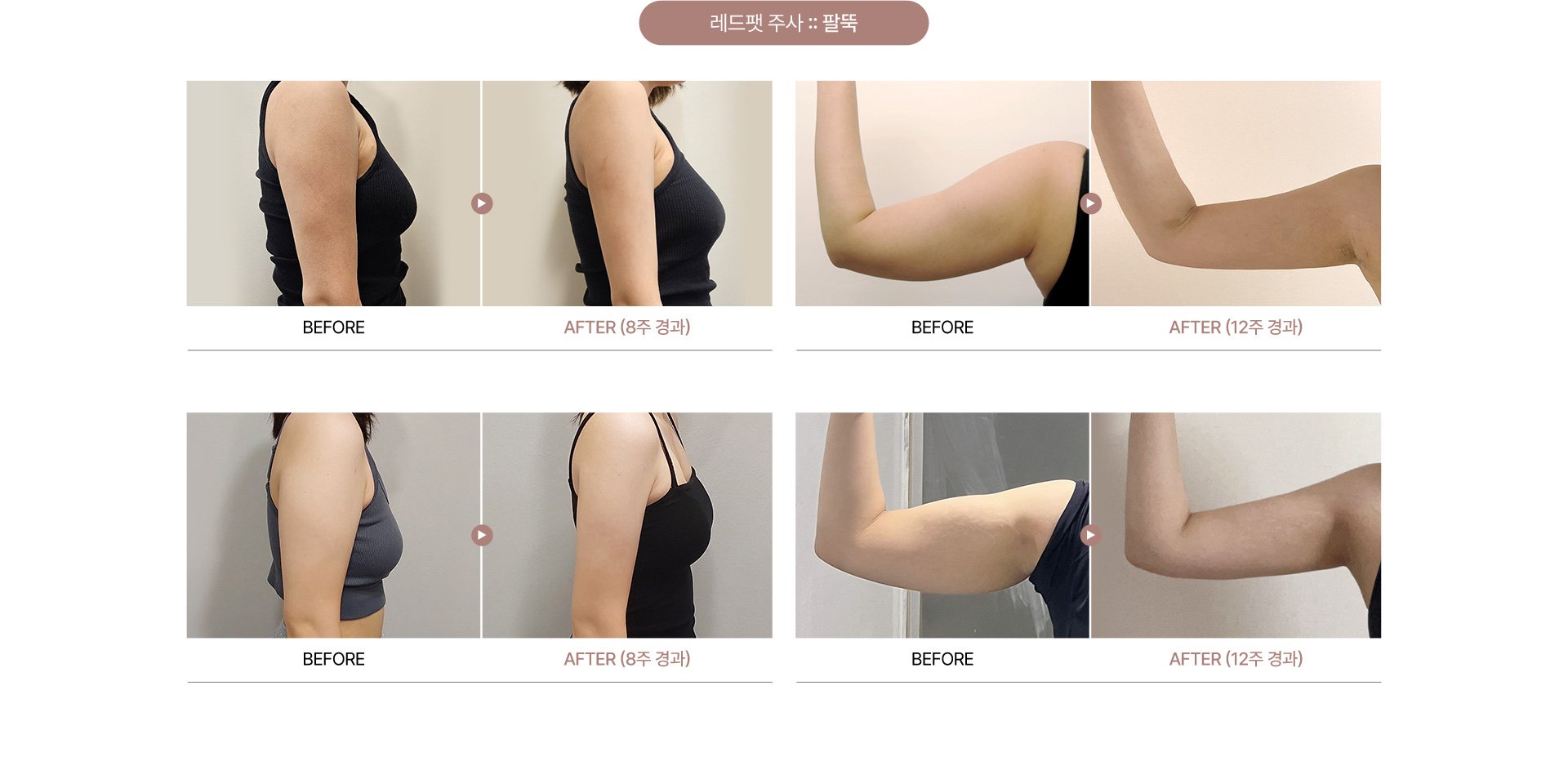 청담쟈스민라인의원 레드팻주사 전후사진